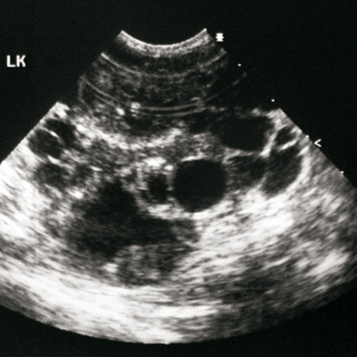 Ultrasound